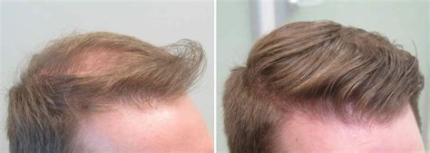 Finasteride Results: How Does Finasteride Work Month by .